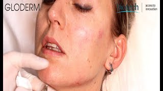 Chin Augmentation Experience