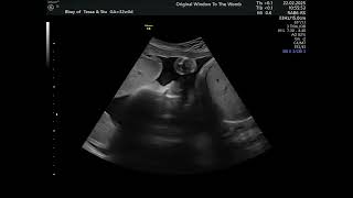 32 weeks 4d/hdlive baby scan