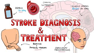 Stroke Diagnosis and Treatment - Acute and Long Term Treatment of Ischemic and Hemorrhagic Stroke
