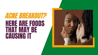 Acne Breakout? Here Are Foods That May Be Causing It