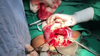 Cesarean delivery / C-section : Surgical technique - HD Video