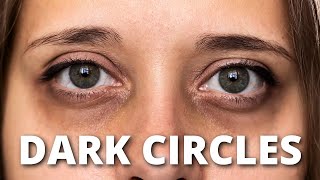 Get Rid of Dark Circles For GOOD with These Techniques