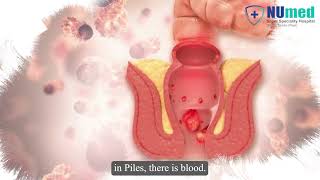 Piles vs. Fistula: Symptoms, Differences & Laser Treatment | Dr. Yogendra Kumar
