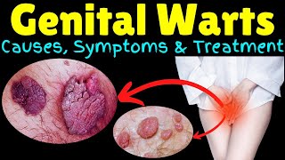 Preventing Genital Warts: Essential Methods You Need to Know