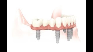 4 Implants Supported Full Arch Bridge