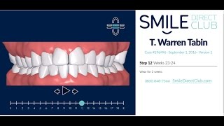 Smile Driect Club Tray 13 April 8 2017 5 more trays to go!!