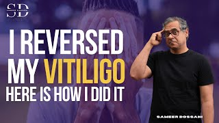 I Was Diagnosed With Vitiligo — Now My Doctor Says I Don’t Have It