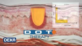 MonaLisa Touch treatment by SmartXide2 (V2LR).wmv.mp4