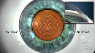 Stephen Slade MD Laser Cataract Surgery Liquefaction