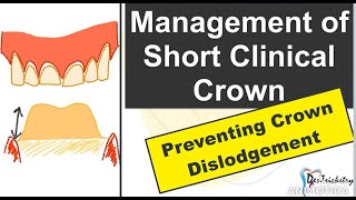 Short Clinical Crown Management (Insufficient Height)/ Improving the Retention and Resistance Form.