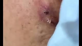 #pimplepoppingvideos #pimples #pimplepopping addiction #poppingpimples