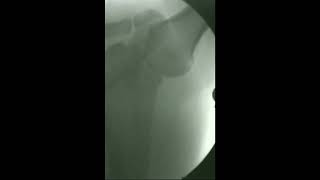Digital Motion X-ray of a Dislocated Shoulder That Was Missed in an MRI