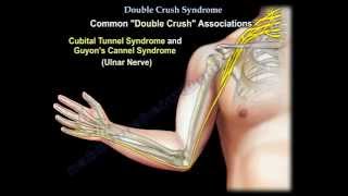 Double Crush Syndrome - Everything You Need To Know - Dr. Nabil Ebraheim