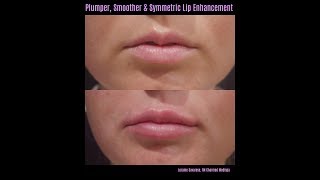 Plumper Smoother and More Symmetric Lips with Dermal Filler Restylane