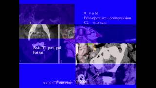 UCSF Radiology: How to Relieve Intractable Headaches