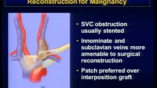 Reconstrução cirúrgica das veias braquiocefálicas na doença benigna e maligna.
