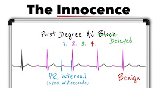 First-Degree AV Block Explained | ECG Interpretation, PR Interval & Clinical Significance