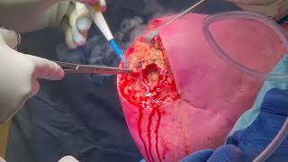 Professor Munjed Al Muderis Performs Two-Stage Osseointegration Revision Surgery - 2nd Stage