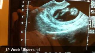 12 week ultrasound