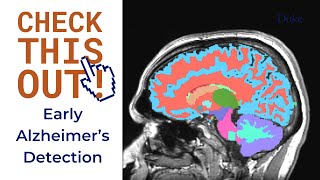 Early Alzheimer's Detection | Check This Out!