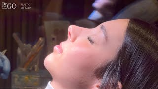 One-Month Secondary Rhinoplasty Follow-Up & Lip Filler Enhancement