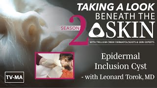 Beneath the Skin - Epidermal Inclusion Cyst