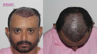 Unfiltered 3-Year Hair Transplant Results | Patient Traveled from Dubai to India | Dr. Suneet Soni