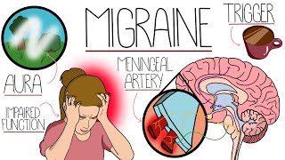 Migraine Explained Clearly (Including Treatment)