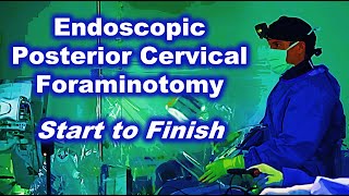 Endoscopic Spine Surgery – Start to Finish Posterior Cervical Foraminotomy with Dr. Derman and Son