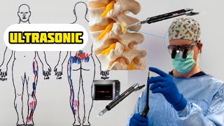 Ultrasonic Spine Surgery (LIVE Answers)