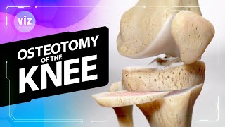 Realigning leg bones to delay knee replacement surgery (3D Animation)