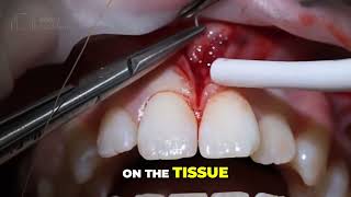 🦷 Diastema Closure | Causes & Best Treatment Options for Dentists