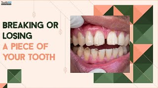 Breaking or losing a piece of your tooth?