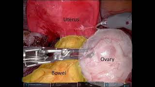 Approach to bowel endometriosis