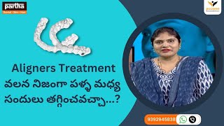 Aligners Treatment వలన నిజంగా పళ్ళ మధ్య సందులు తగ్గించవచ్చా? #aligners #parthadental #shorts