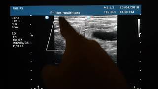 Live ! From Emergency Hospital  ... Acute Appendicitis  ...