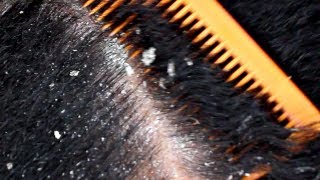 Satisfying Dandruff Removal | HUGE FLAKES !!!