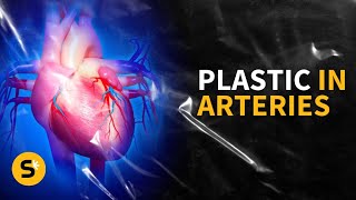 Microplastics were found in artery deposits
