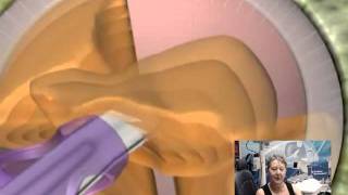 SuperSight Surgery : Lens Replacement Surgery