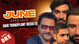 Hair Transplant in India | Best Results at Best Cost of Hair Transplant