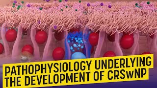 Pathophysiology Underlying the Development of CRSwNP