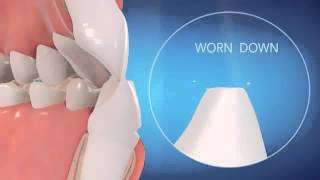 Invisalign Hixson TN - Straighten Your Teeth at Signature Smiles