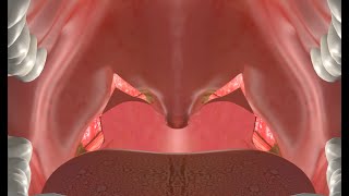 Pharyngoplastie latérale pour l'apnée du sommeil