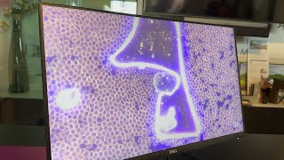 Dark Field - Live Blood Analysis Sept 2024 (non injected) with micro clots, AI.