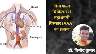 बिना शल्य चिकित्सा से महाधमनी विस्फार का ईलाज - Treatment of AAA without Surgery  By Dr. Vinod Kumar