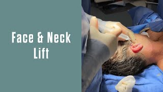 Face & Neck Lift