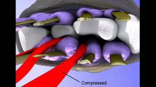 Whitfords Chiropractor Carpal Tunnel Syndrome