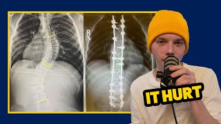 I Got A Spinal Fusion (A Scoliosis Story)