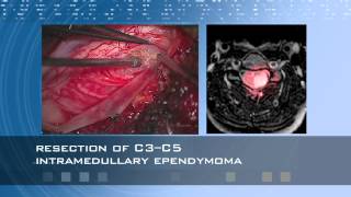 Intramedullary Ependymoma   Spetzler Experience in HD