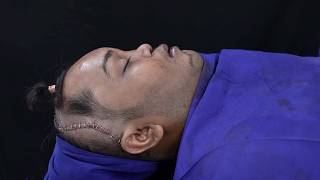 Young Man’s Face Rebuilt After Bike Accident